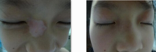 白癜风康复案例