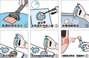 黑色素细胞自体体外再生术